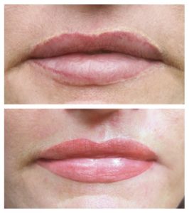 2-Korrektur-einer-fleckigen-Verzeichnung-der-Lippen-durch-professionelles-Permanent-Make-up-Fachpraxis-in-Glashütten-Oberems_1100x1146