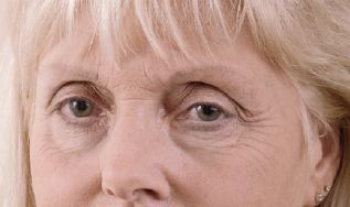 Augenbrauenneugestaltung